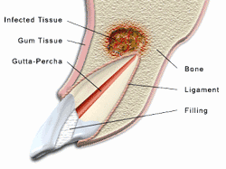 apicoectomy, endodontic surgery